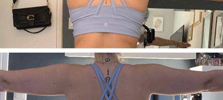 Joliens (24) Leben mit einer Fettverteilungsstörung