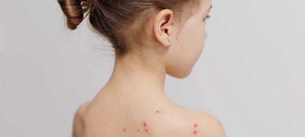 Windpocken und Röteln