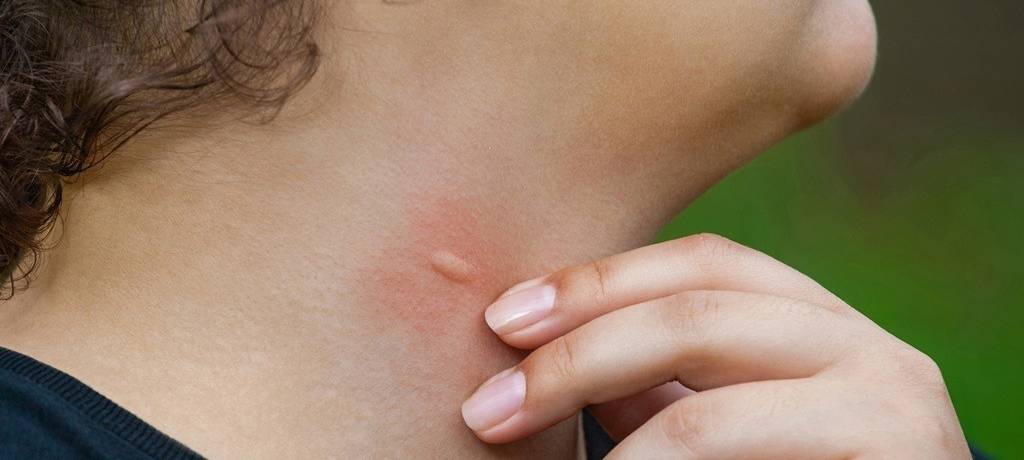 Detailansicht einer Frau mit einer Schwellung am Hals nach einem Insektenstich